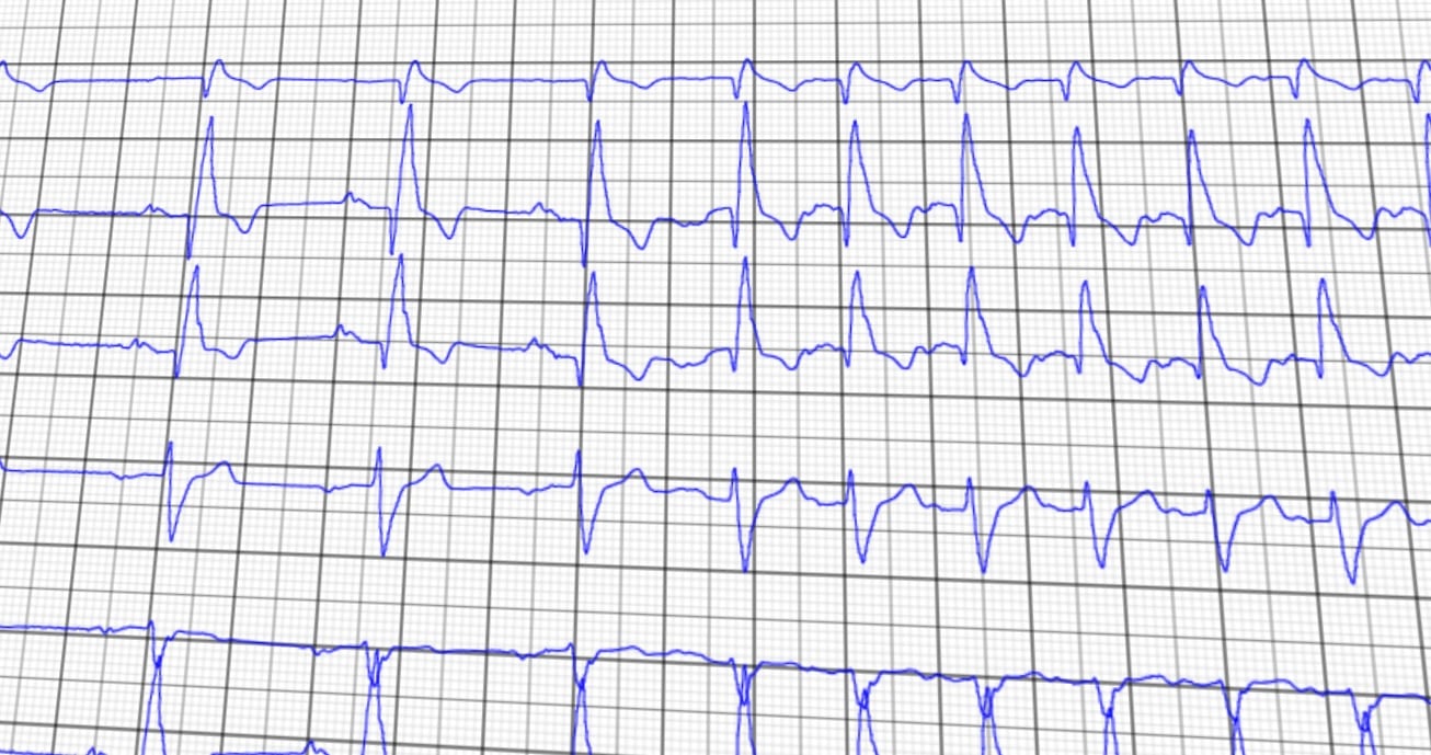 Resting electrocardiogram tracing